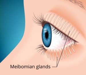 glandes de meibomius et oeil sec