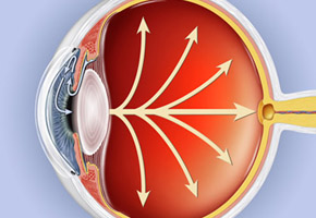 pression intraoculaire glaucome