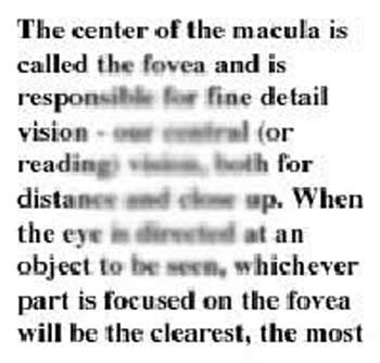 DMLA Vision centrale avec distorsion 